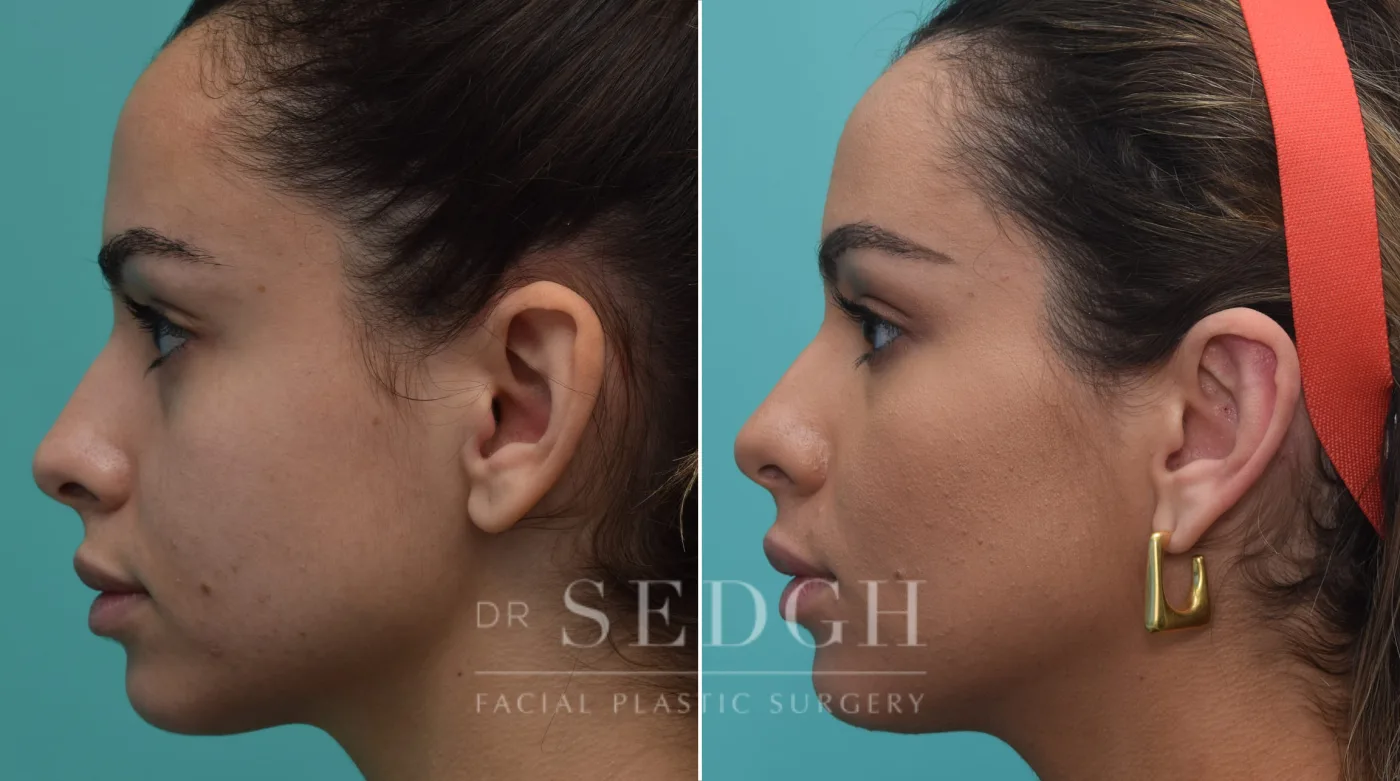 Patient 194 after Ear Pinning Surgery, view 1