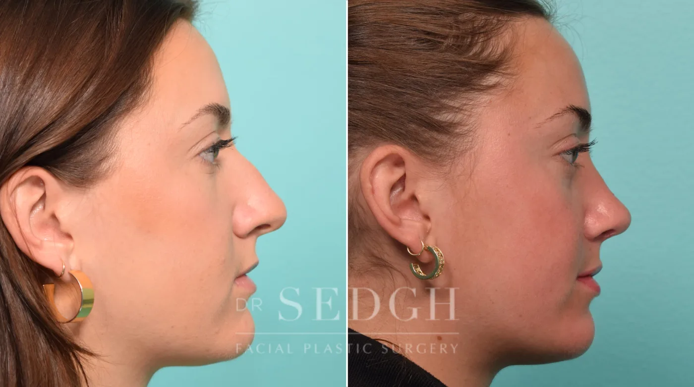 Patient 297 after Rhinoplasty, view 1