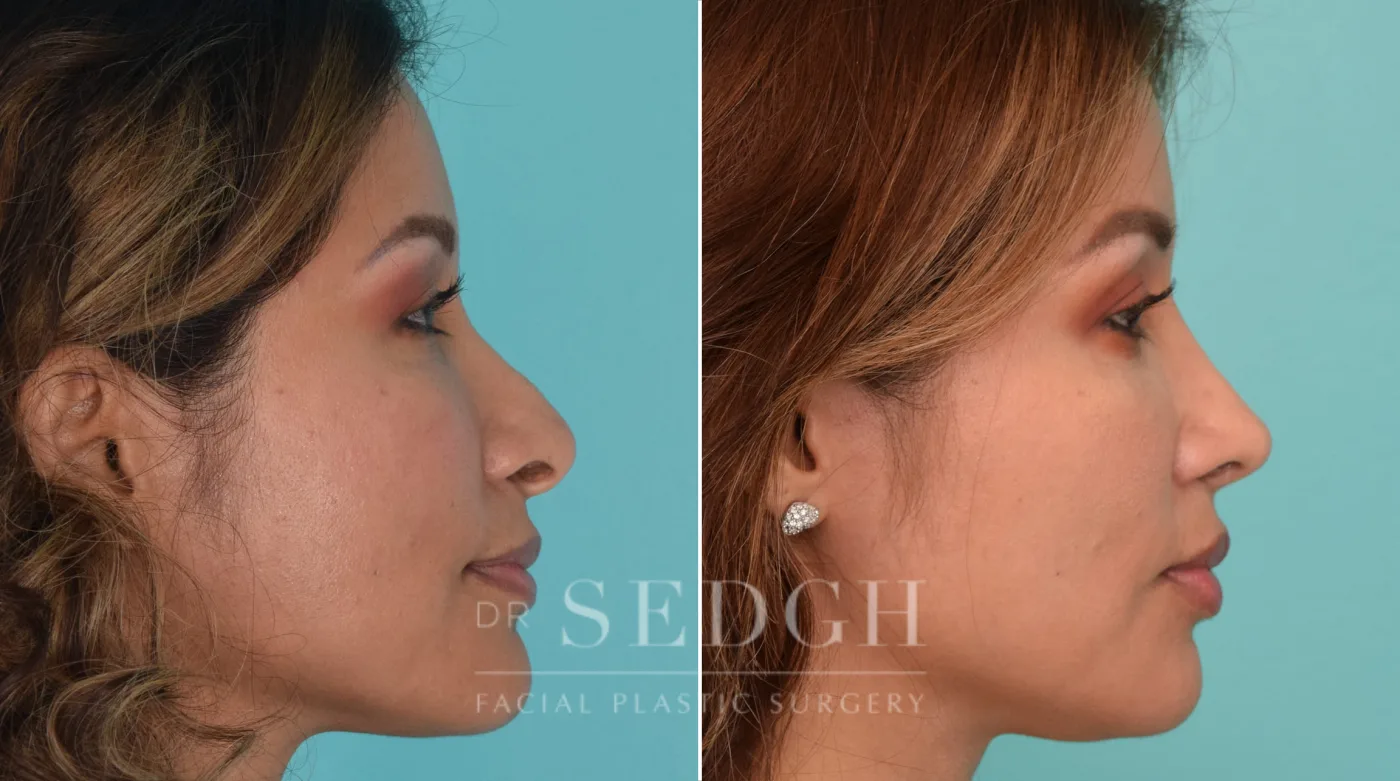 Patient 207 after Revision Rhinoplasty, view 2