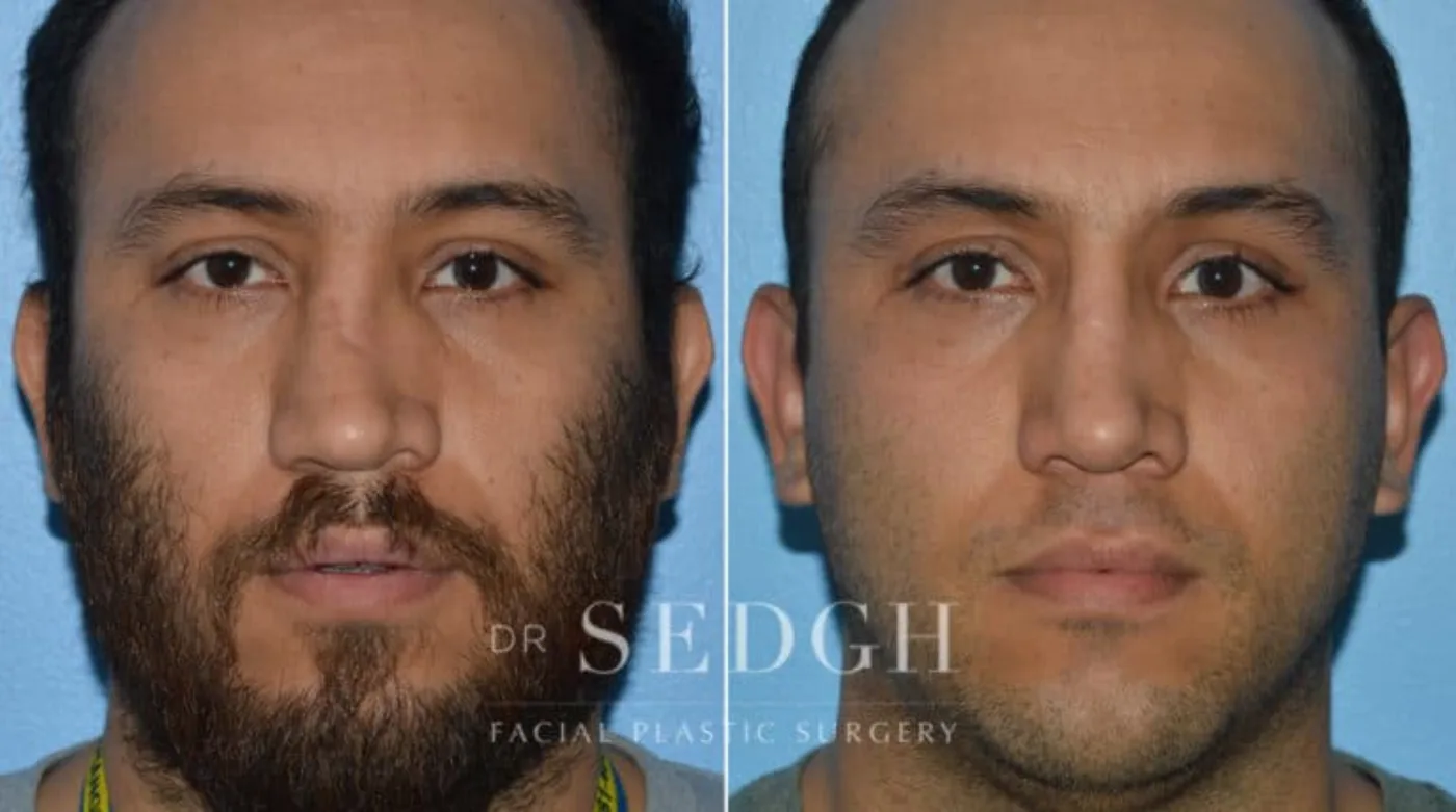 Patient 15 before Crooked Nose Surgery, view 1