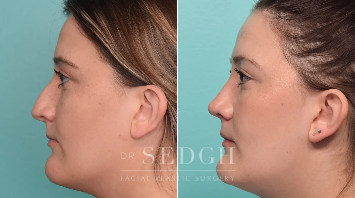 Patient 303 after Rhinoplasty, view 2