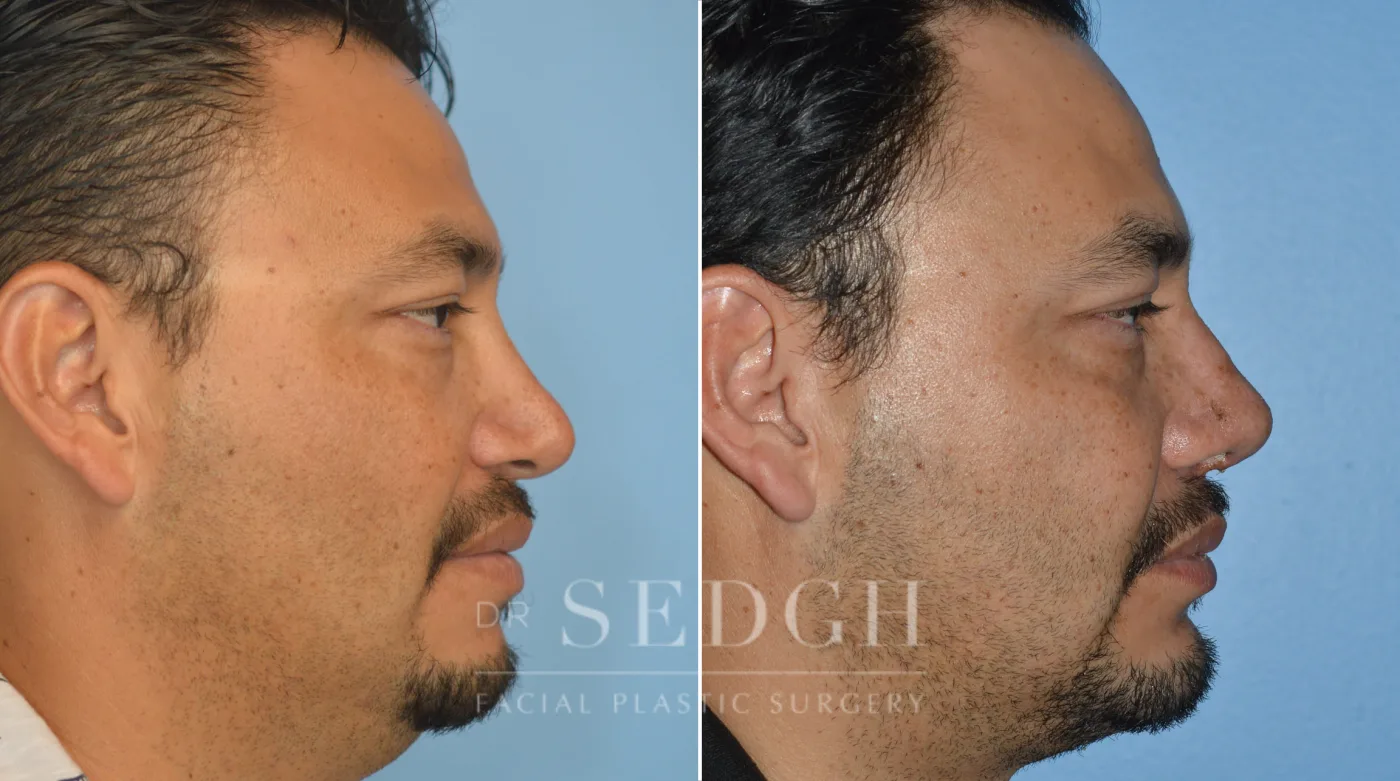 Patient 80 after Chin Augmentation, view 1