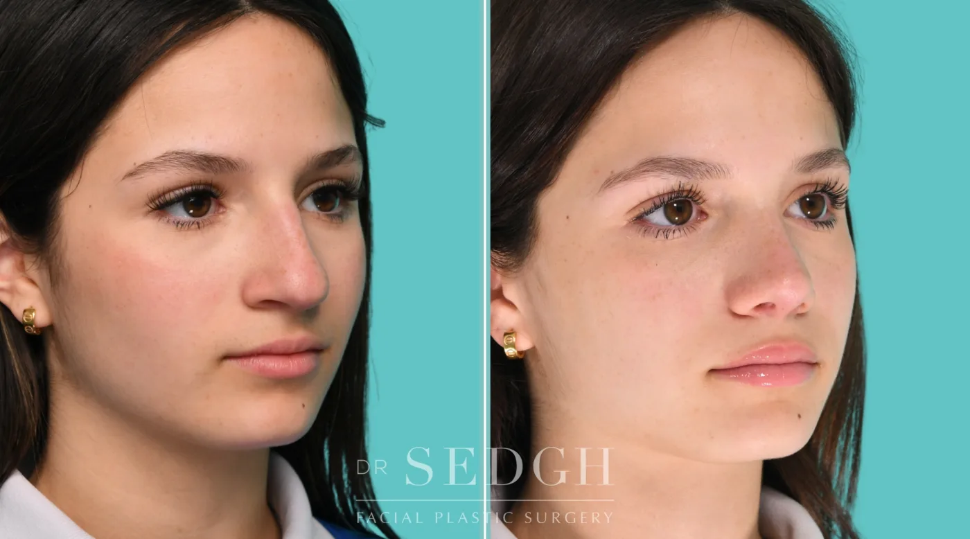 Patient 350 before Middle Eastern Rhinoplasty, view 4