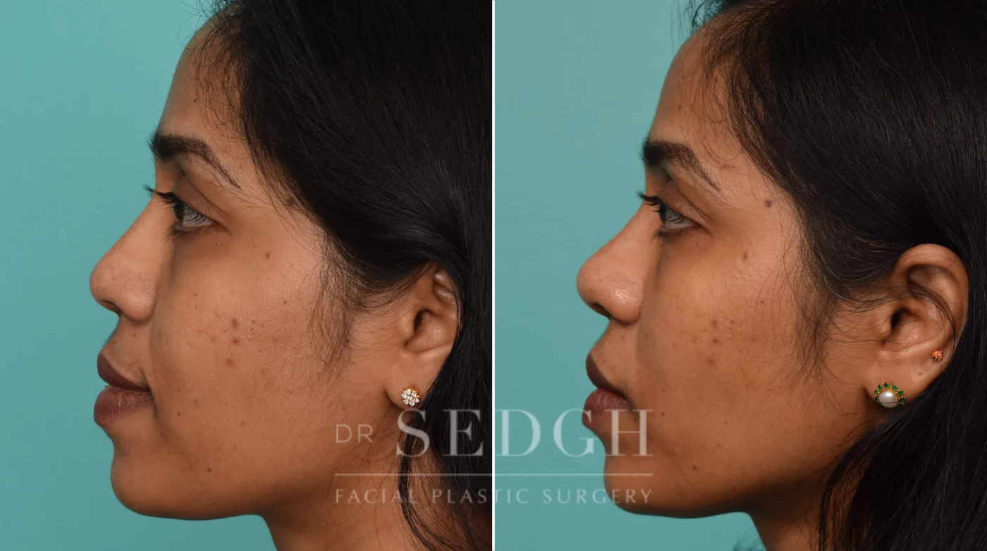Patient 219 after Liquid Rhinoplasty, view 1
