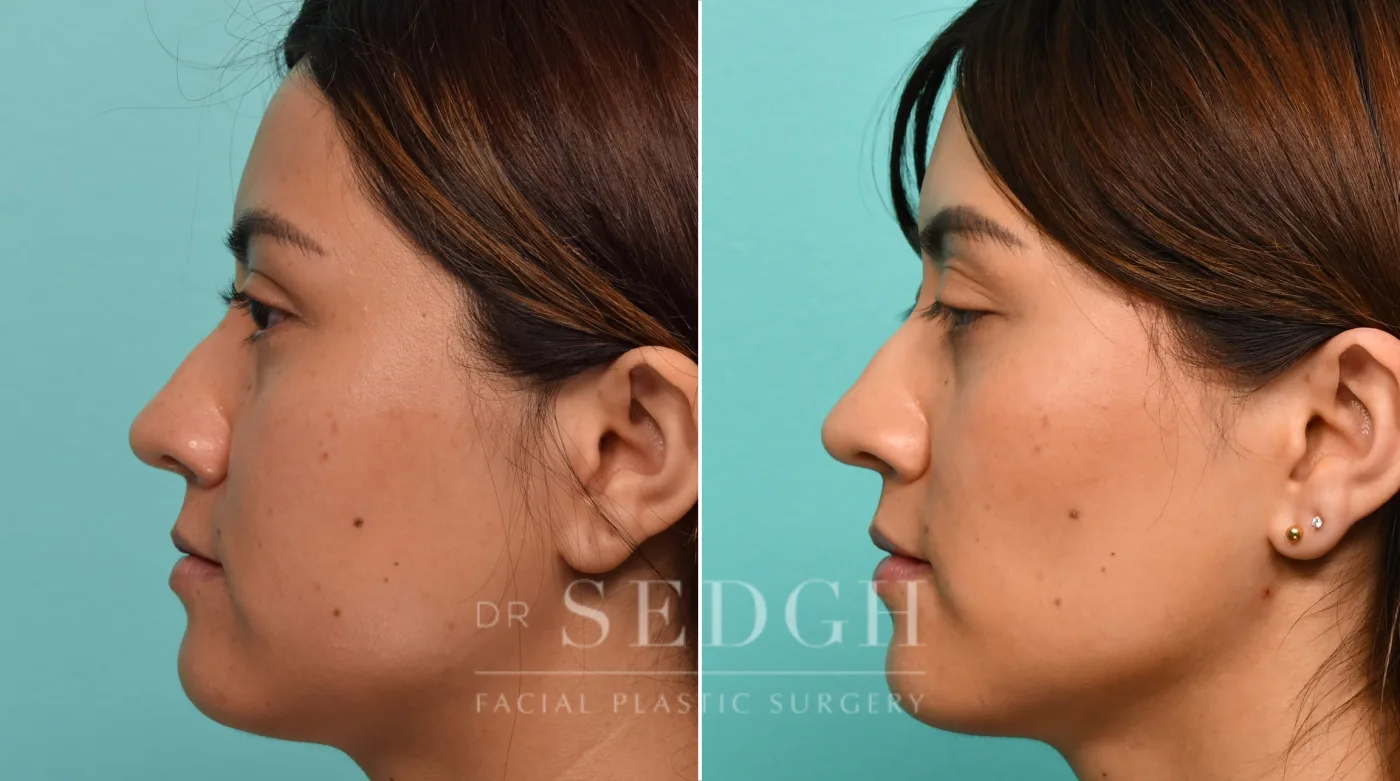 Patient 307 after Buccal Fat Reduction, view 2