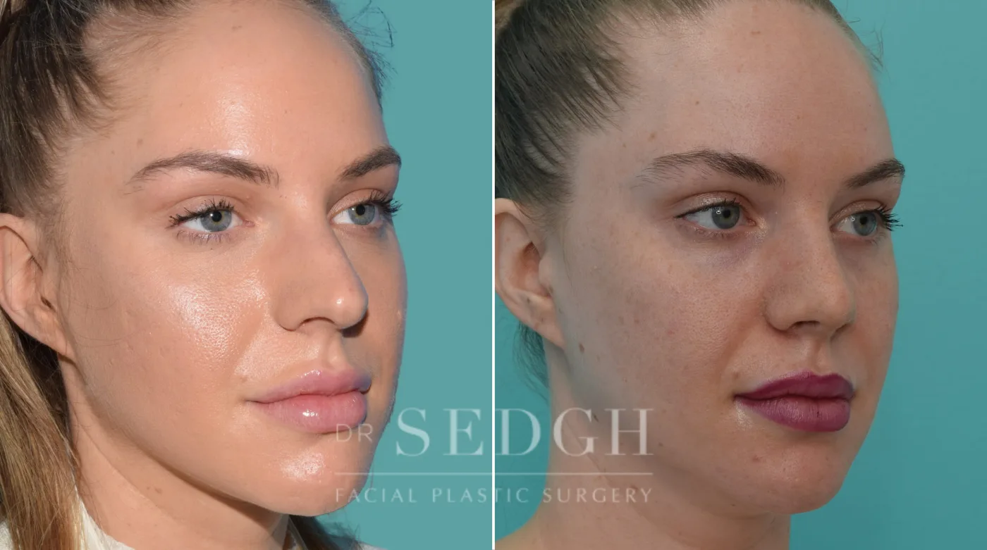 Patient 187 before Crooked Nose Surgery, view 2