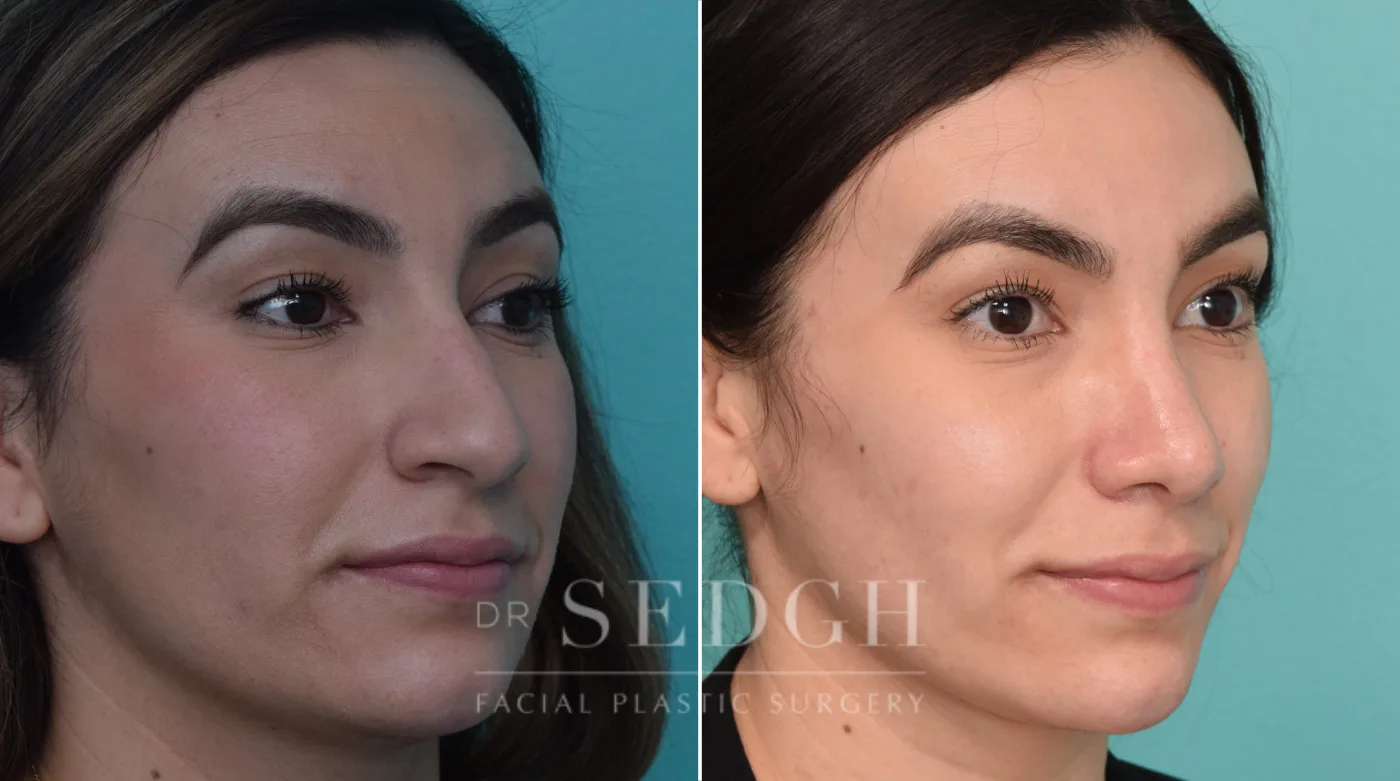 Patient 227 before Hispanic Rhinoplasty, view 1