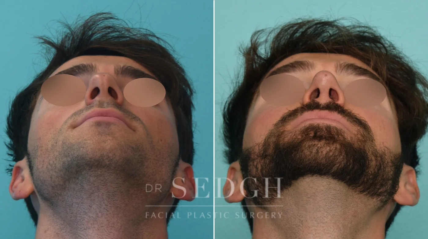 Patient 273 after Male Rhinoplasty, view 3