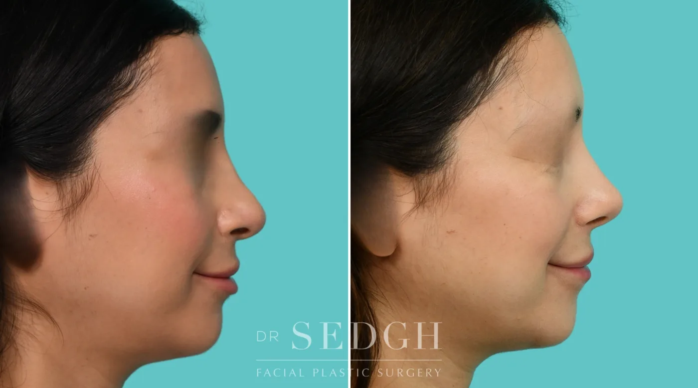 Patient 354 after Revision Rhinoplasty, view 1