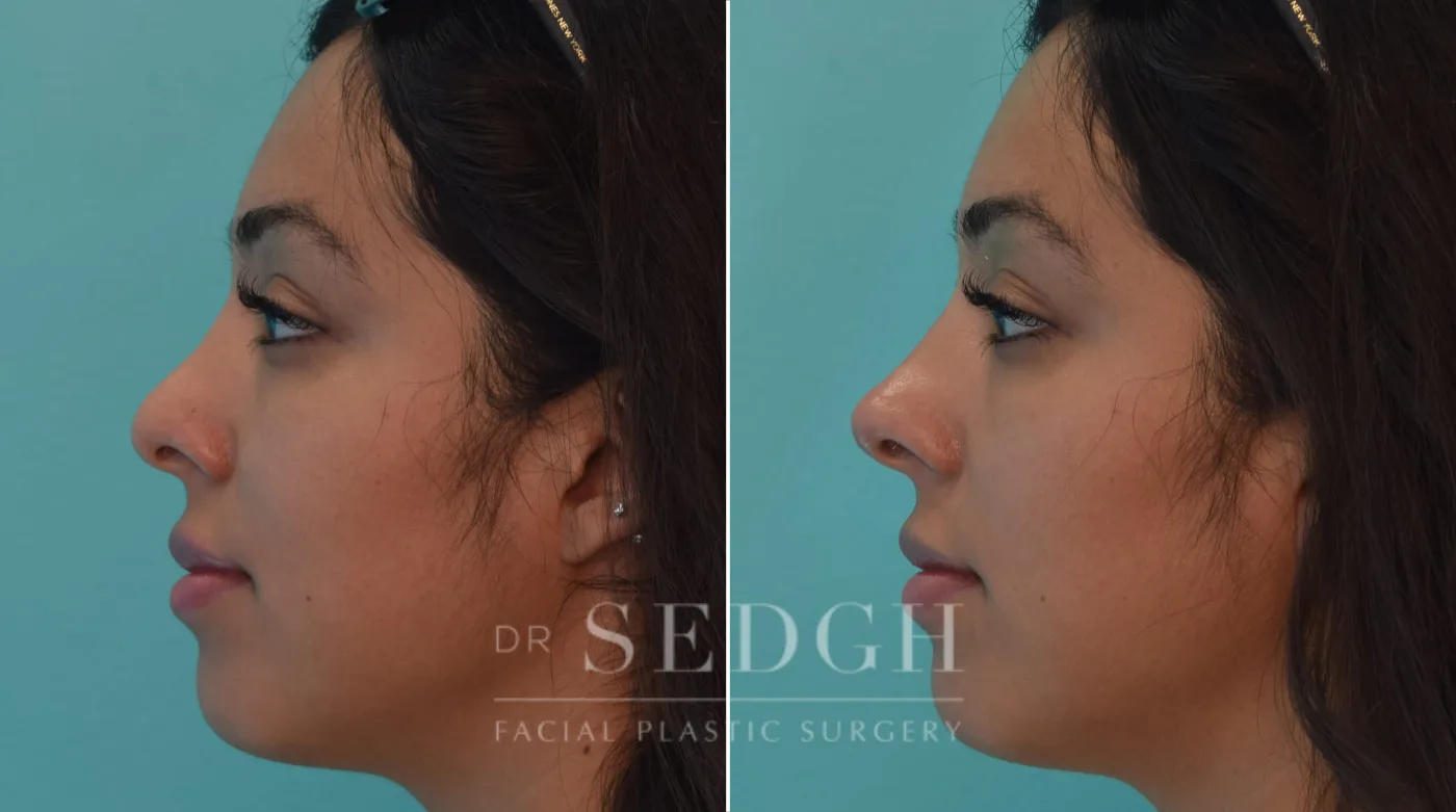 Patient 220 after Liquid Rhinoplasty, view 1