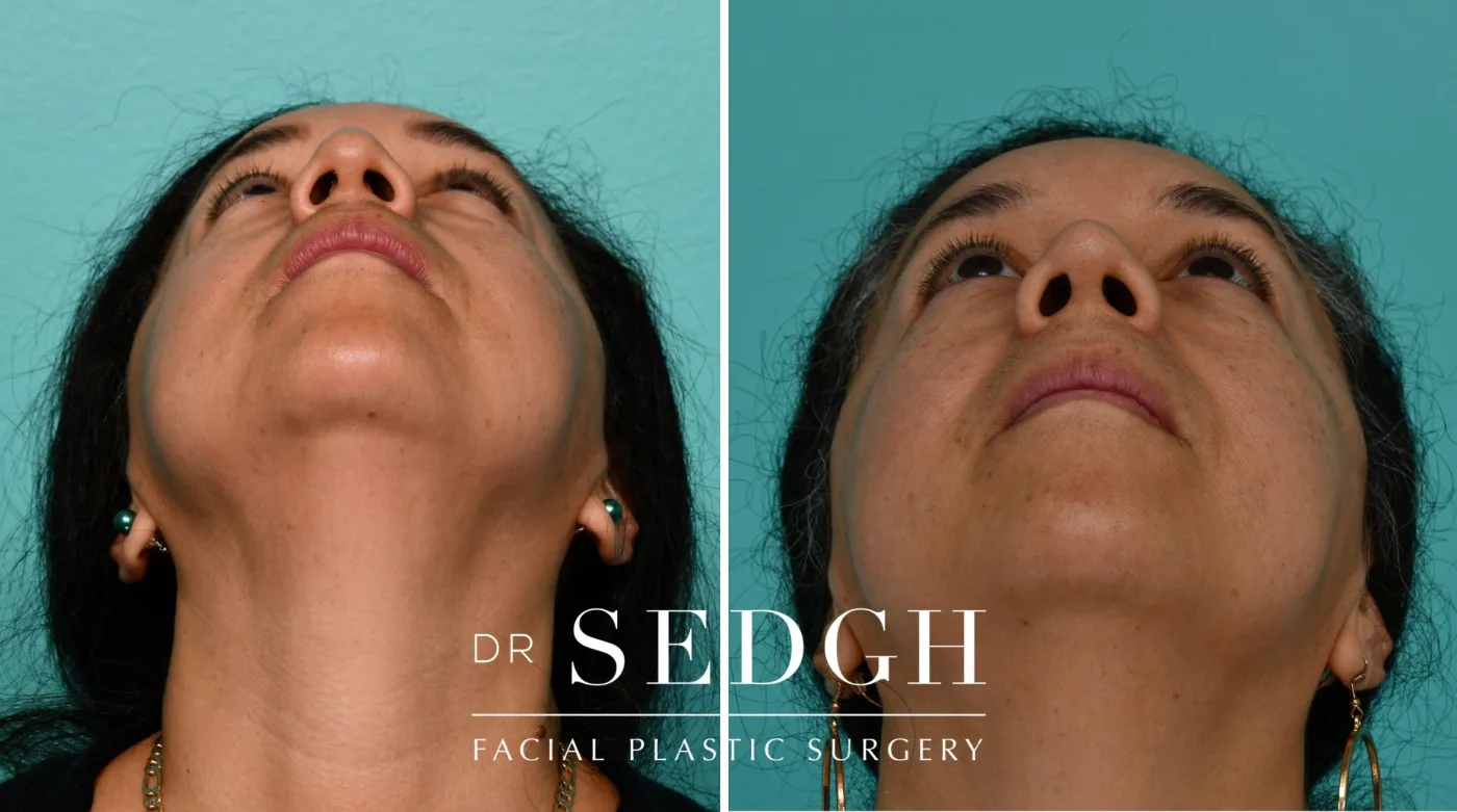 Patient 334 before Female Rhinoplasty, view 3