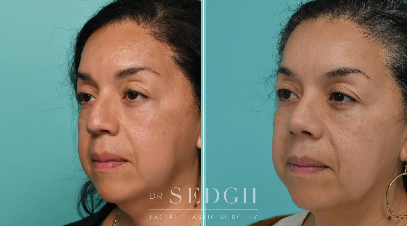 Patient 341 after Hispanic Rhinoplasty, view 1
