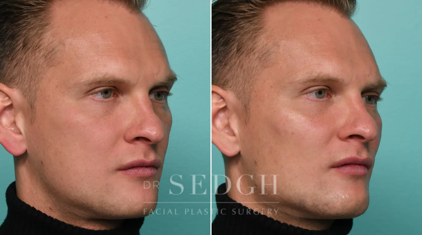 Patient 318 before Chin Filler, view 1