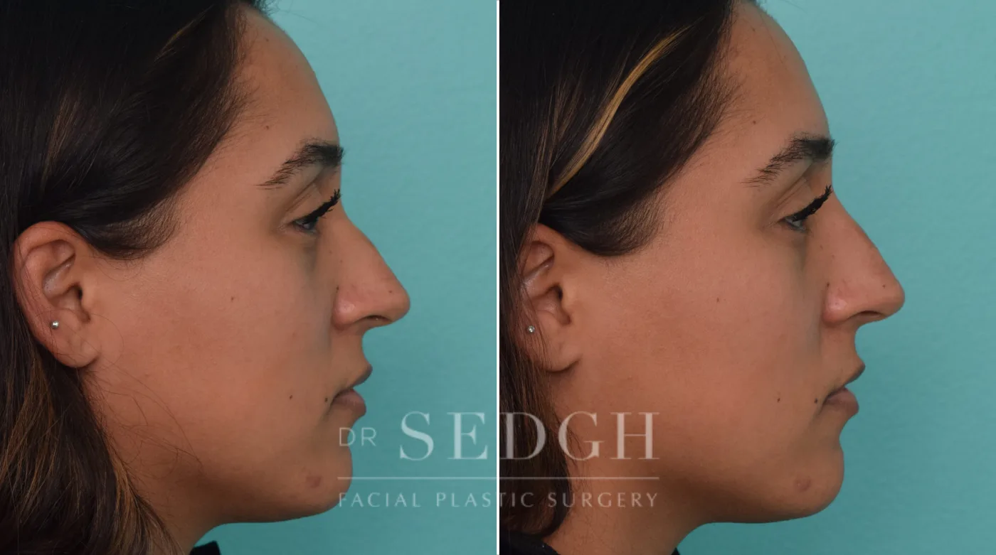 Patient 217 after Liquid Rhinoplasty, view 1