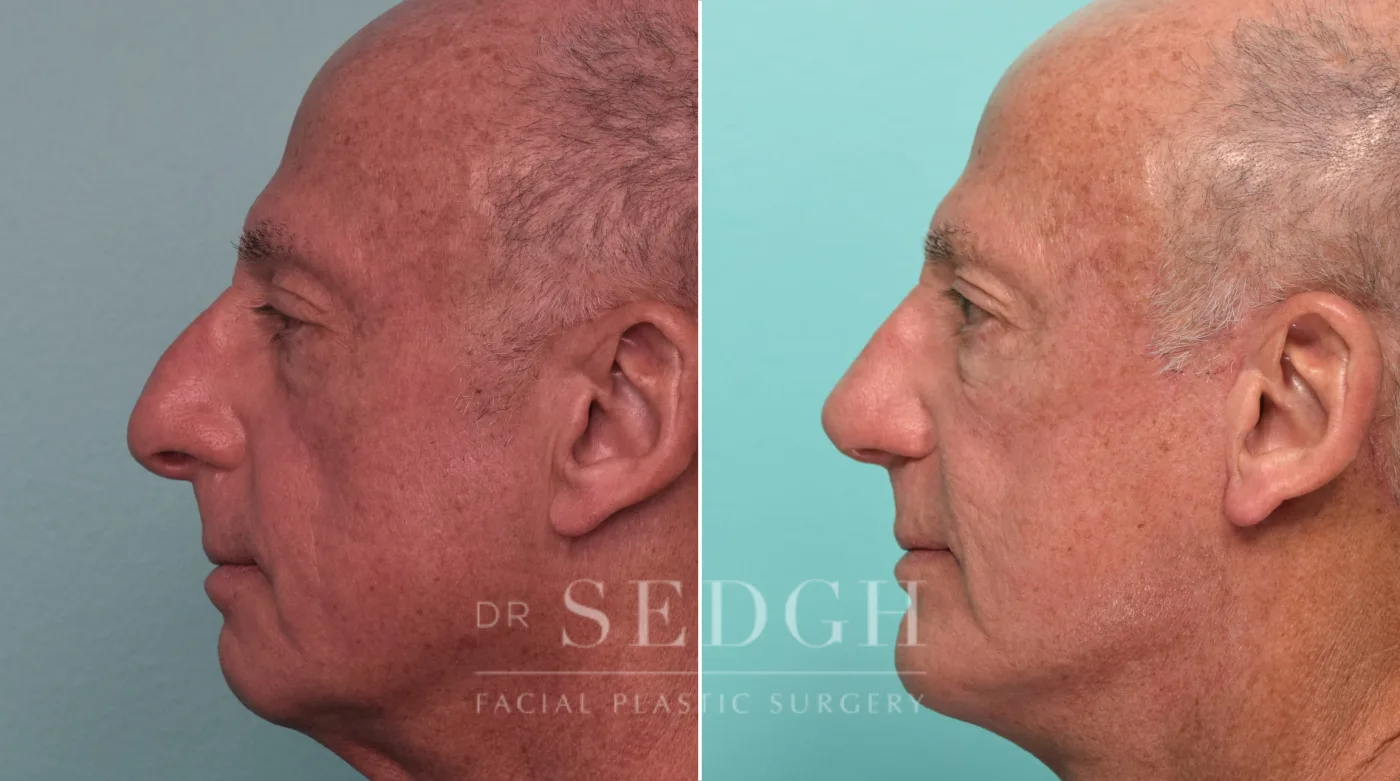 Patient 292 after Face Lift, view 2