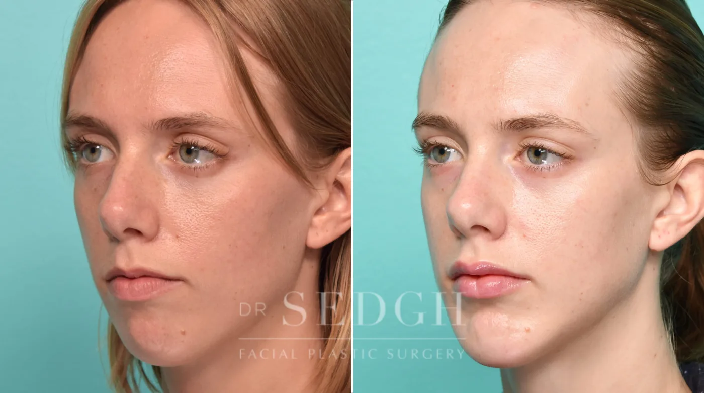 Patient 311 before Chin Augmentation, view 1