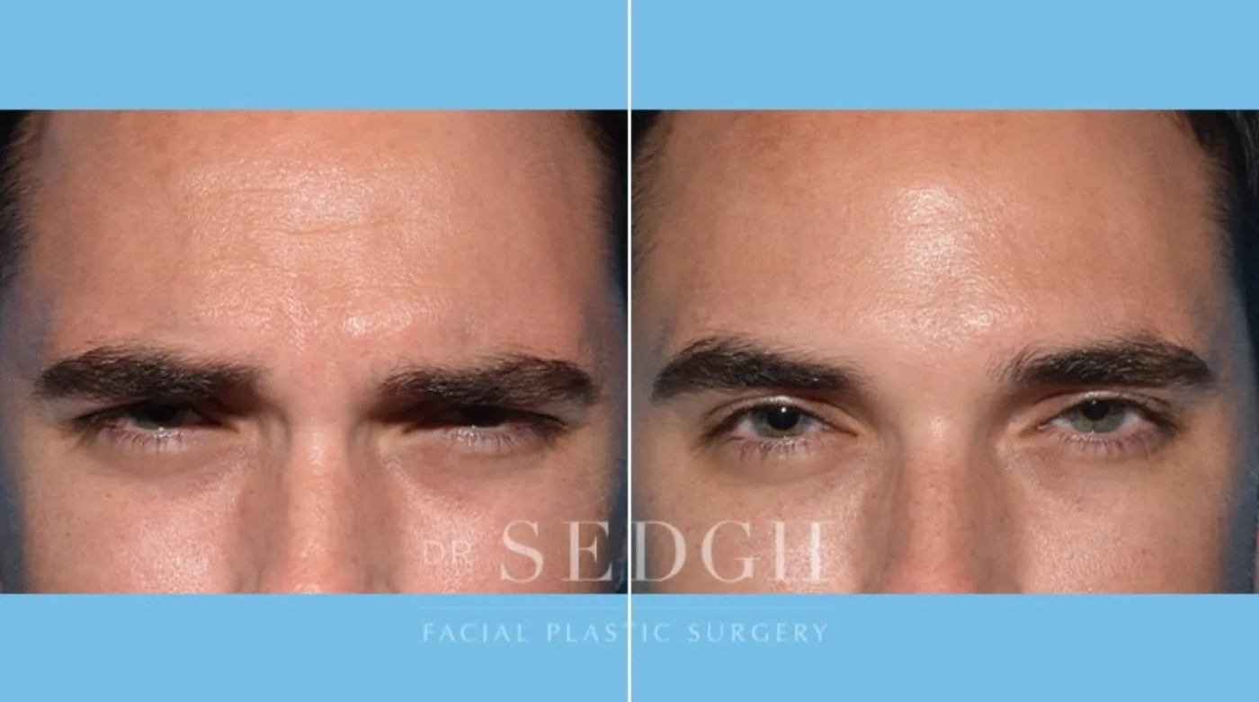 Patient 4 after Wrinkle Relaxers, view 1