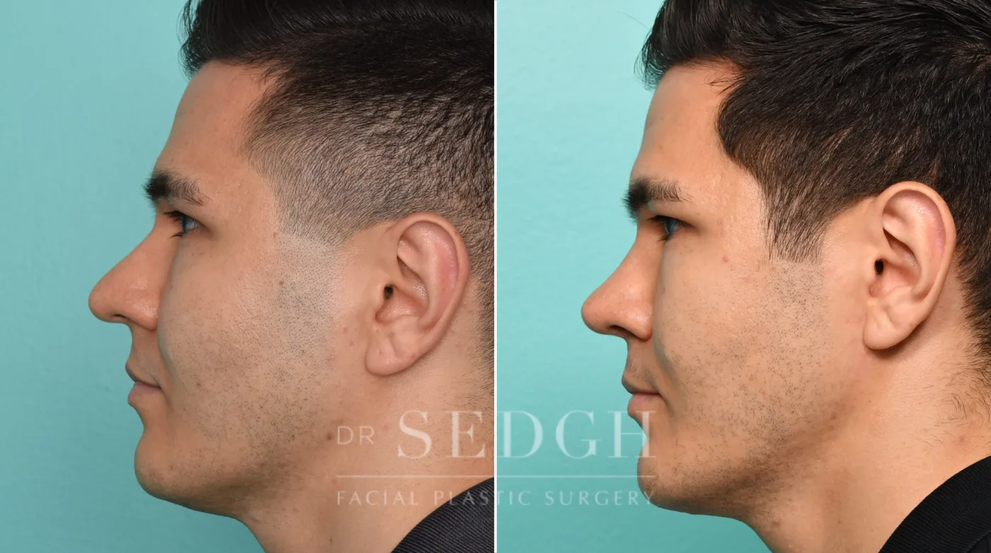 Patient 306 after Chin Augmentation, view 2