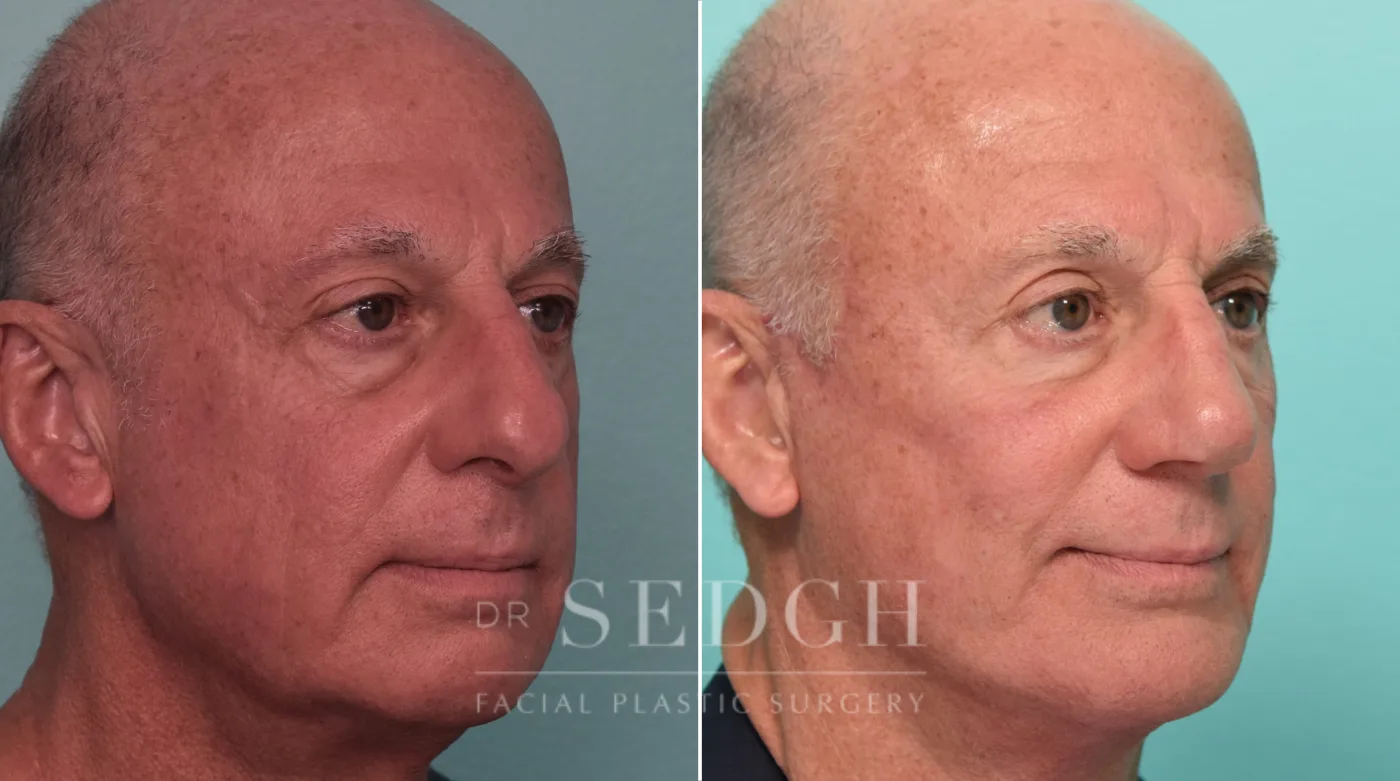 Patient 292 before Face Lift, view 1