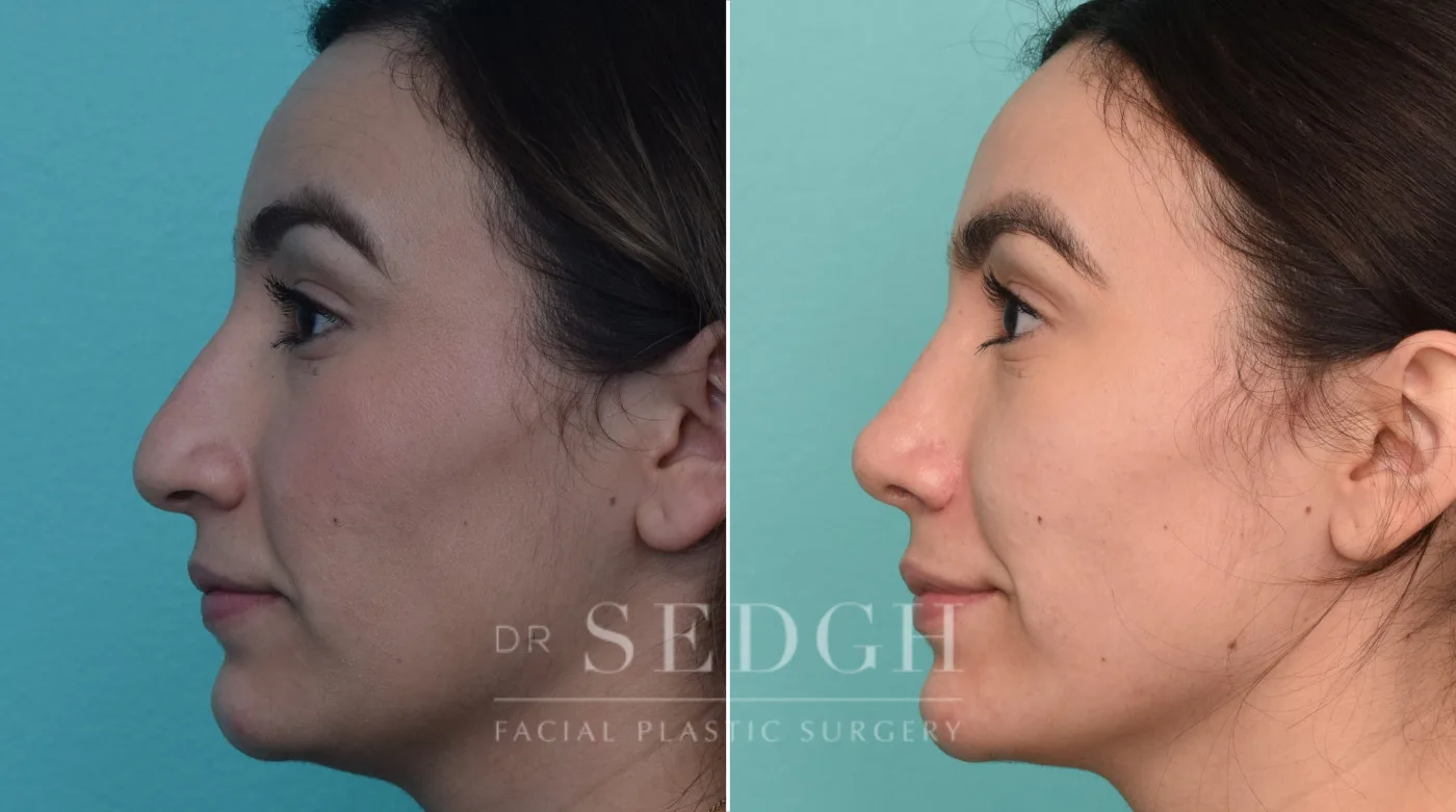 Patient 227 after Hispanic Rhinoplasty, view 2