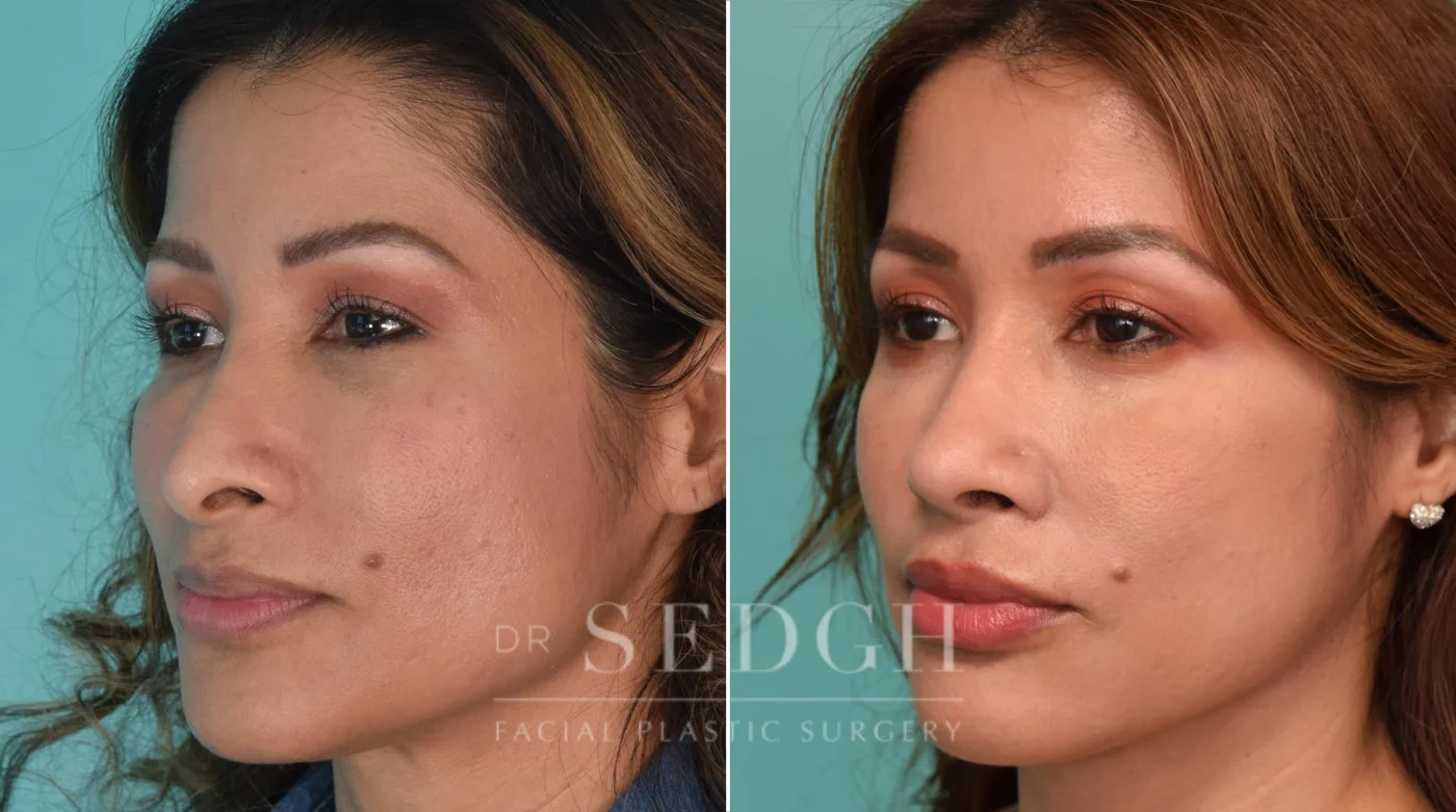 Patient 207 before Revision Rhinoplasty, view 1