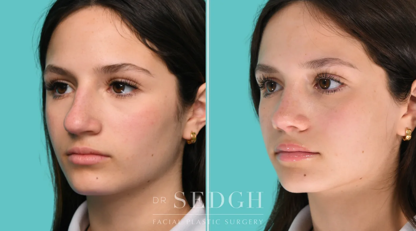 Patient 350 before Middle Eastern Rhinoplasty, view 3
