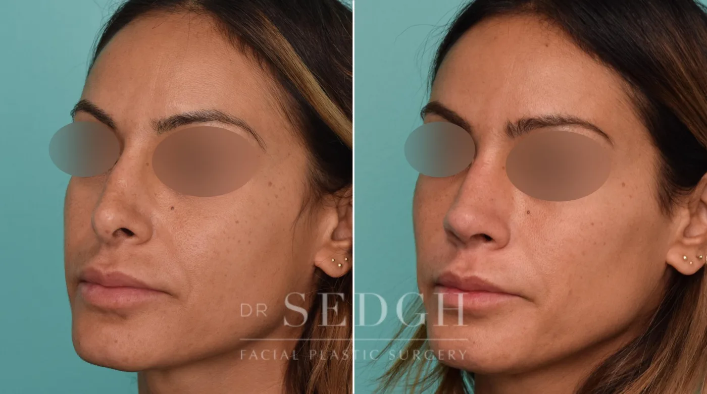 Patient 259 before Revision Rhinoplasty, view 2