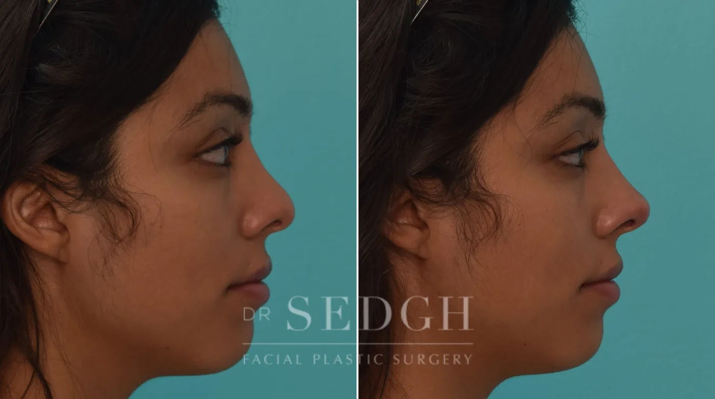Patient 192 after Facial Fillers, view 1