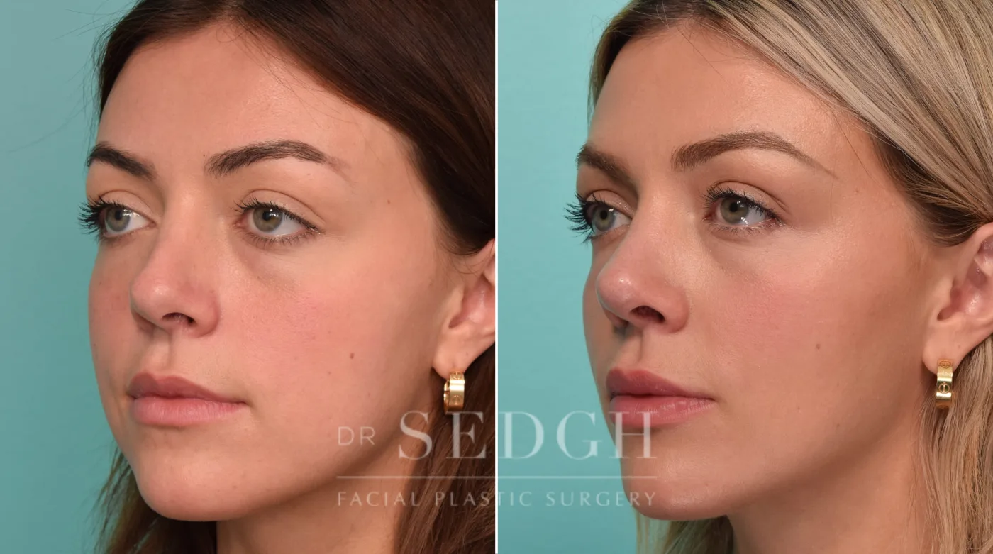 Patient 279 before Revision Rhinoplasty, view 2