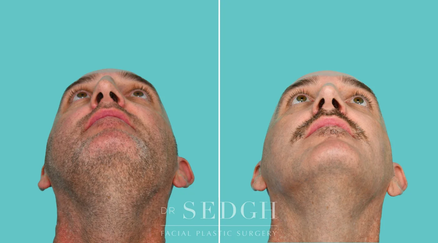 Patient 343 before Crooked Nose Surgery, view 4