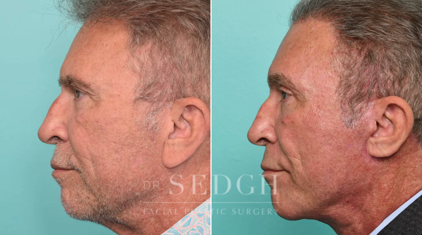 Patient 315 after Face Lift, view 1