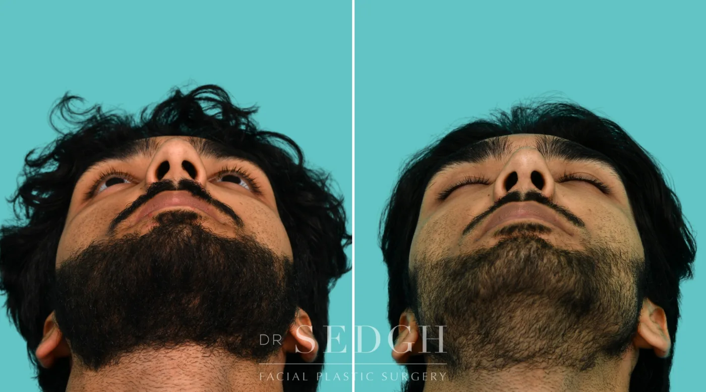 Patient 364 after Male Rhinoplasty, view 4