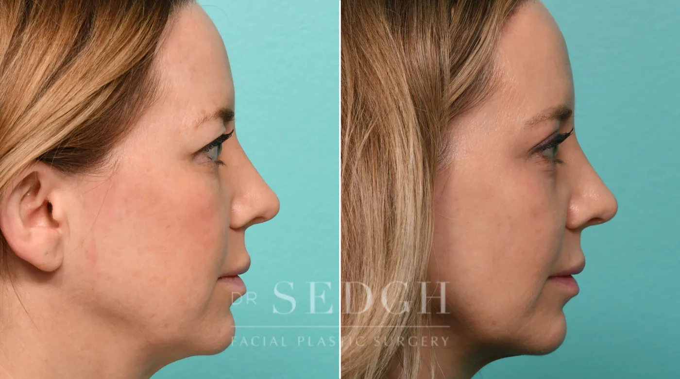Patient 322 after Brow Lift, view 1