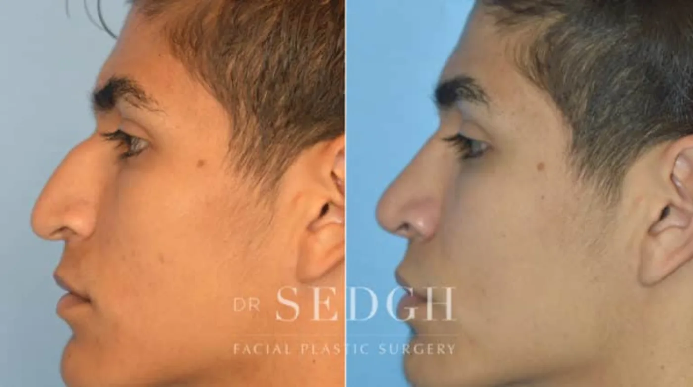 Patient 2 before Hispanic Rhinoplasty, view 1