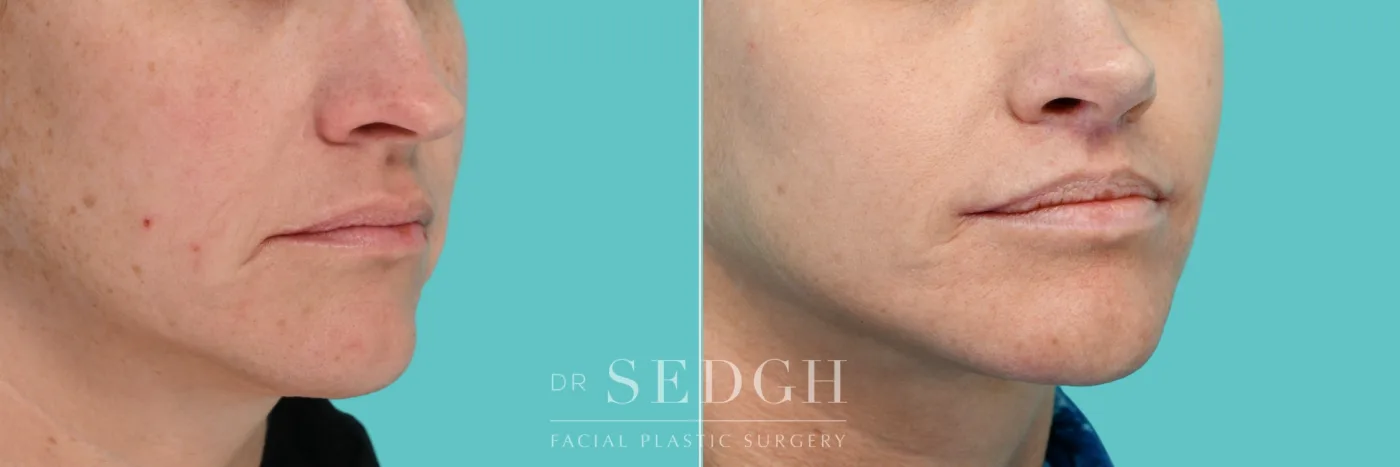 Patient 352 after Lip Lift, view 2