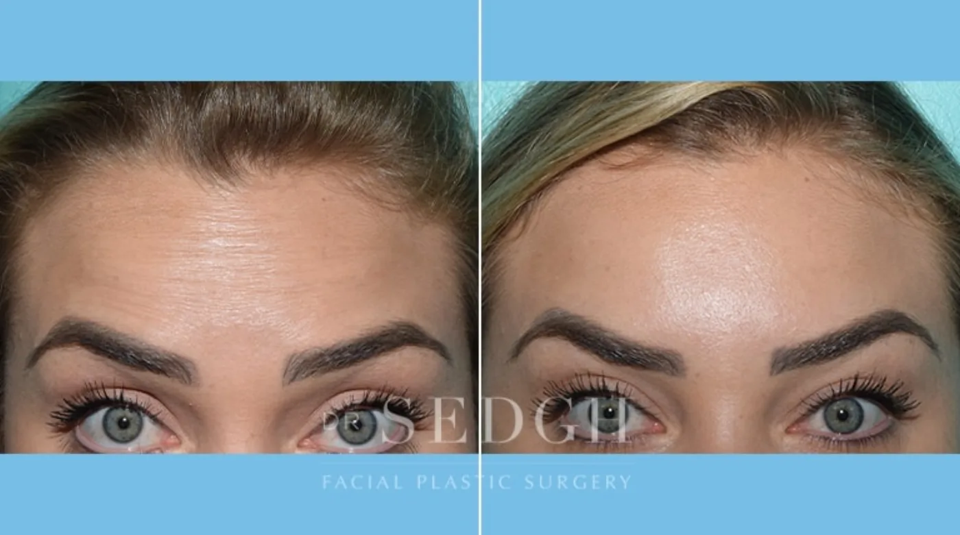 Patient 5 before Wrinkle Relaxers, view 1