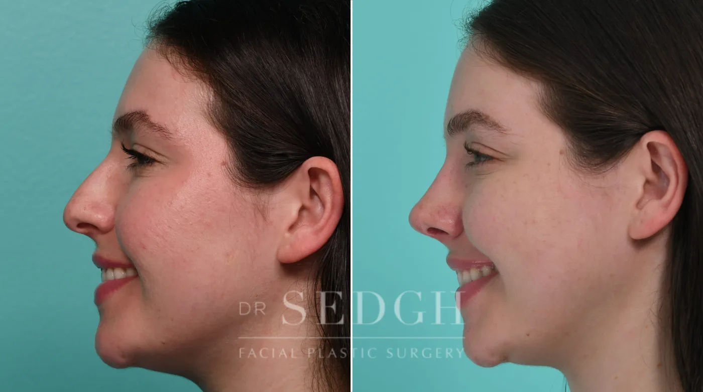 Patient 326 after Rhinoplasty, view 1