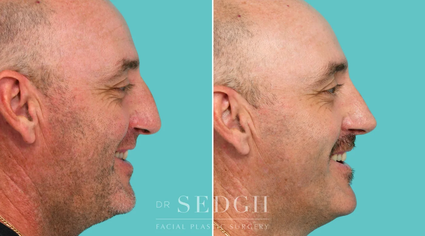 Patient 343 before Crooked Nose Surgery, view 2