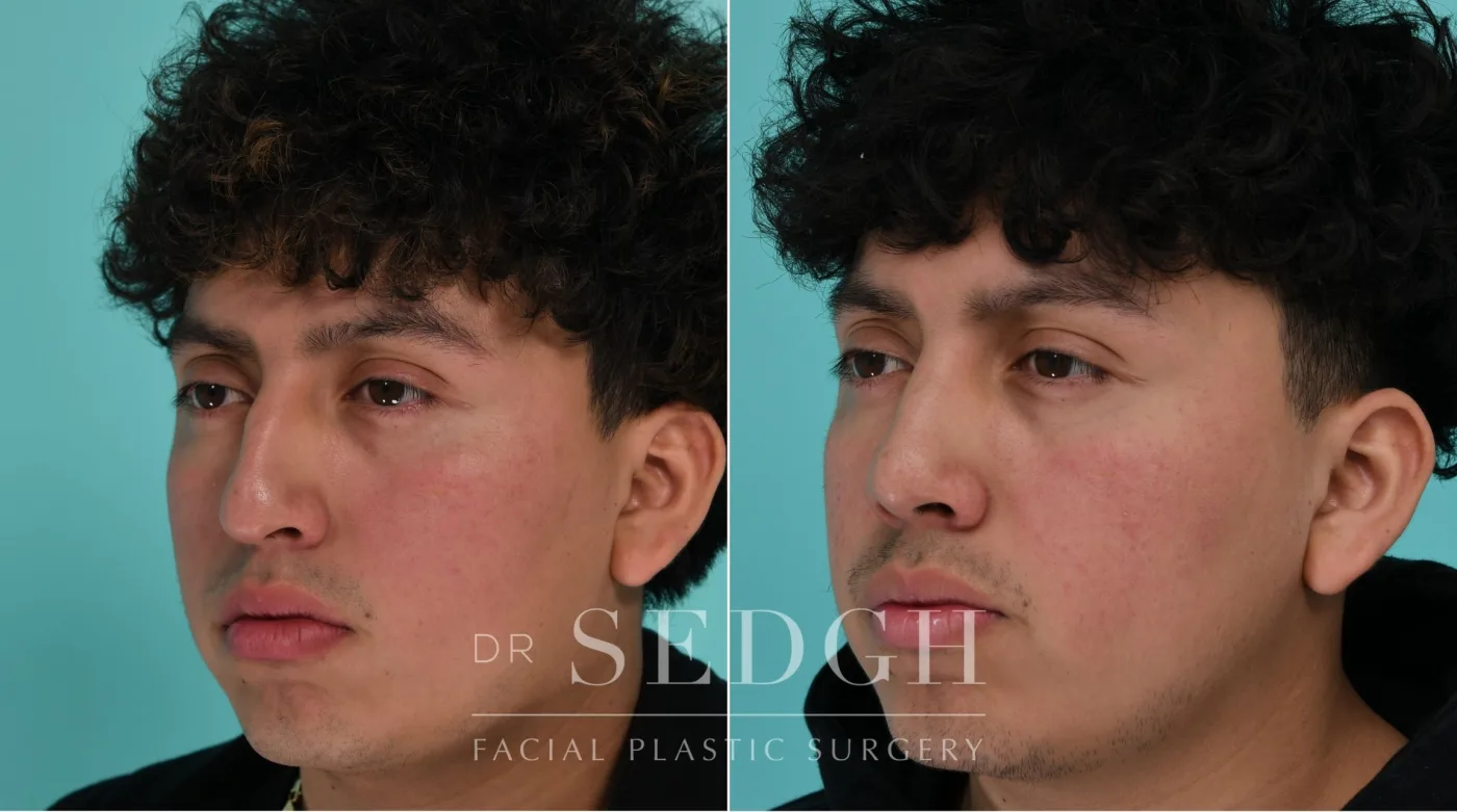 Patient 339 before Male Rhinoplasty, view 2