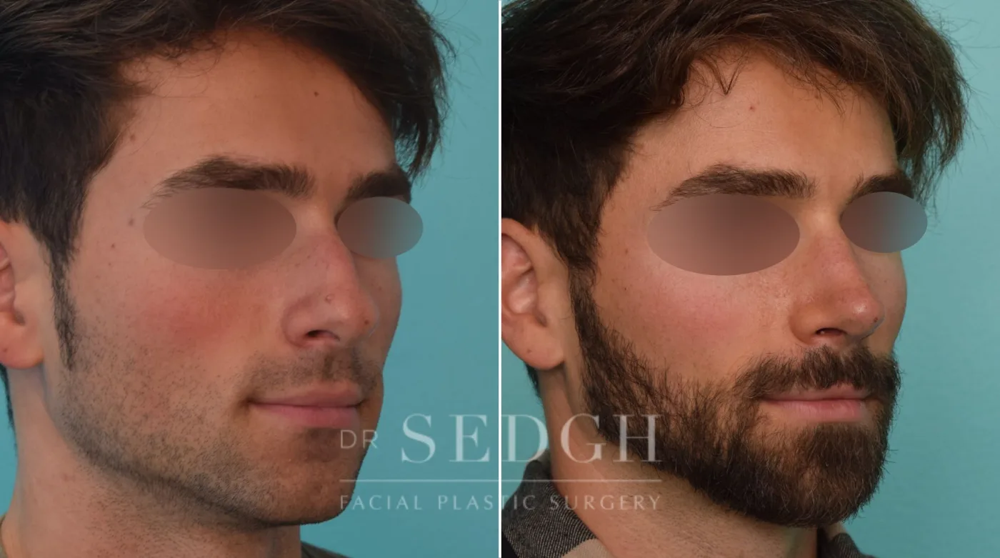 Patient 273 after Male Rhinoplasty, view 2
