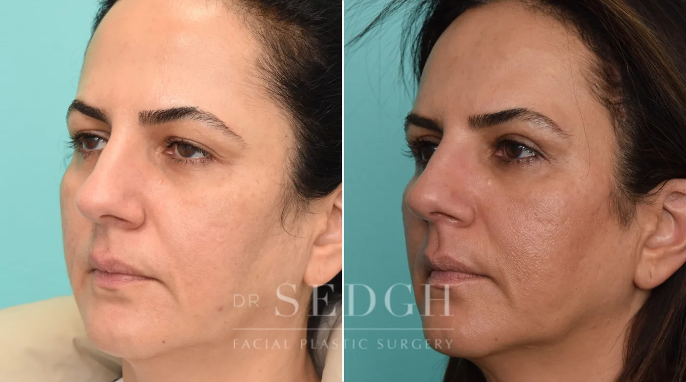 Patient 252 before Brow Lift, view 1