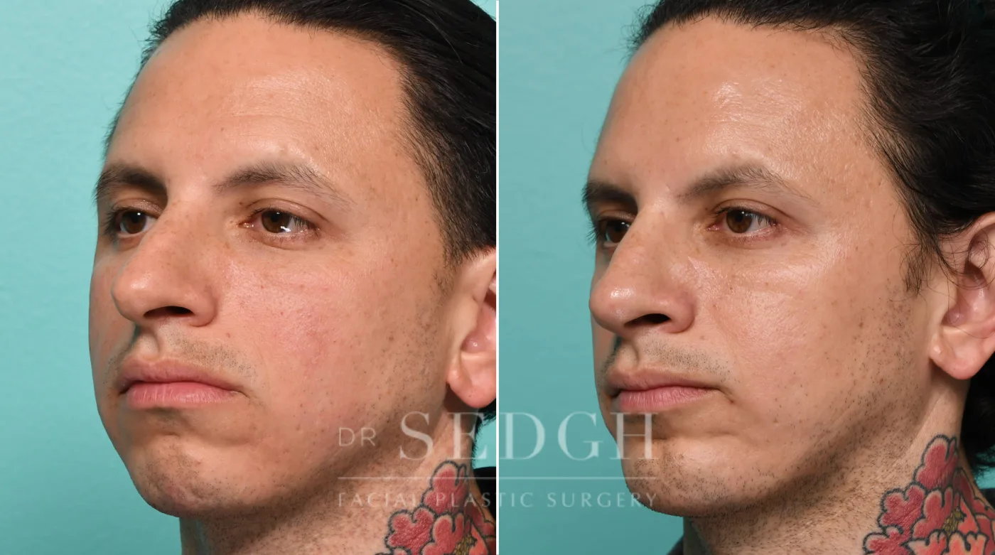 Patient 323 before Chin Augmentation, view 2