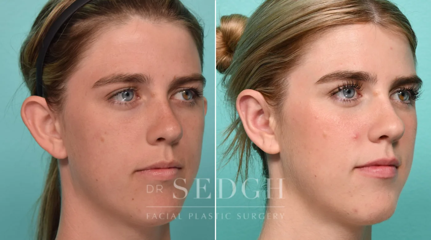 Patient 314 before Ear Pinning Surgery, view 2