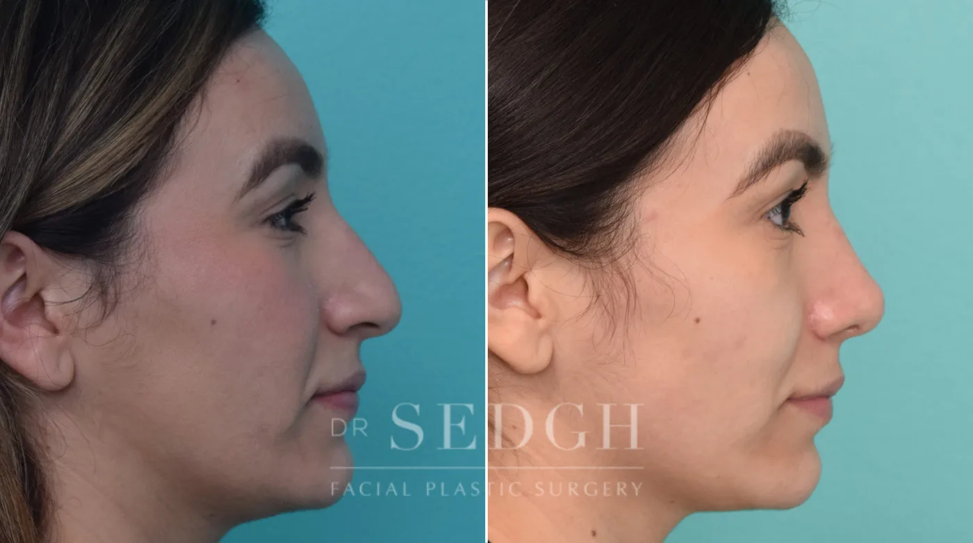 Patient 227 after Hispanic Rhinoplasty, view 1