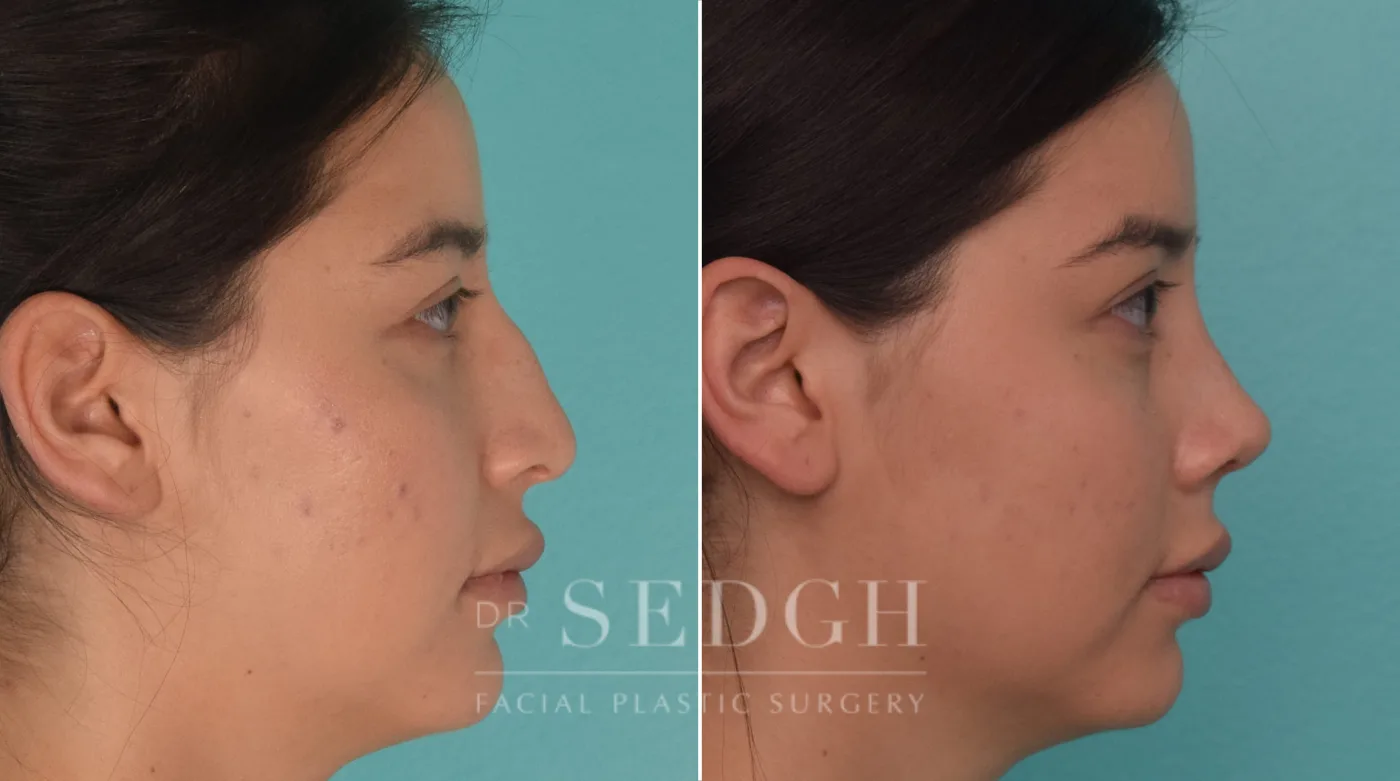 Patient 191 after Female Rhinoplasty, view 2