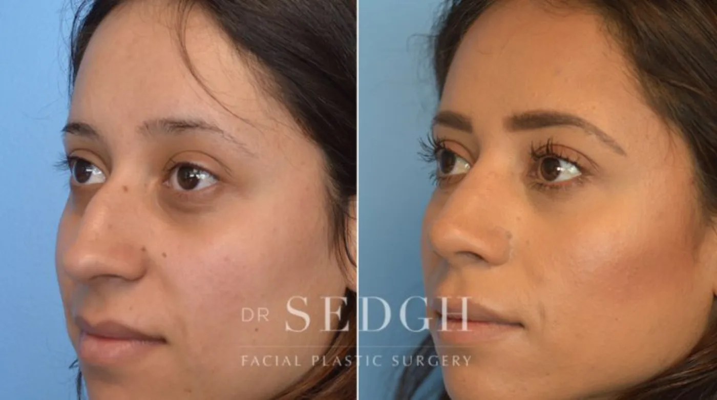 Patient 7 before Hispanic Rhinoplasty, view 1