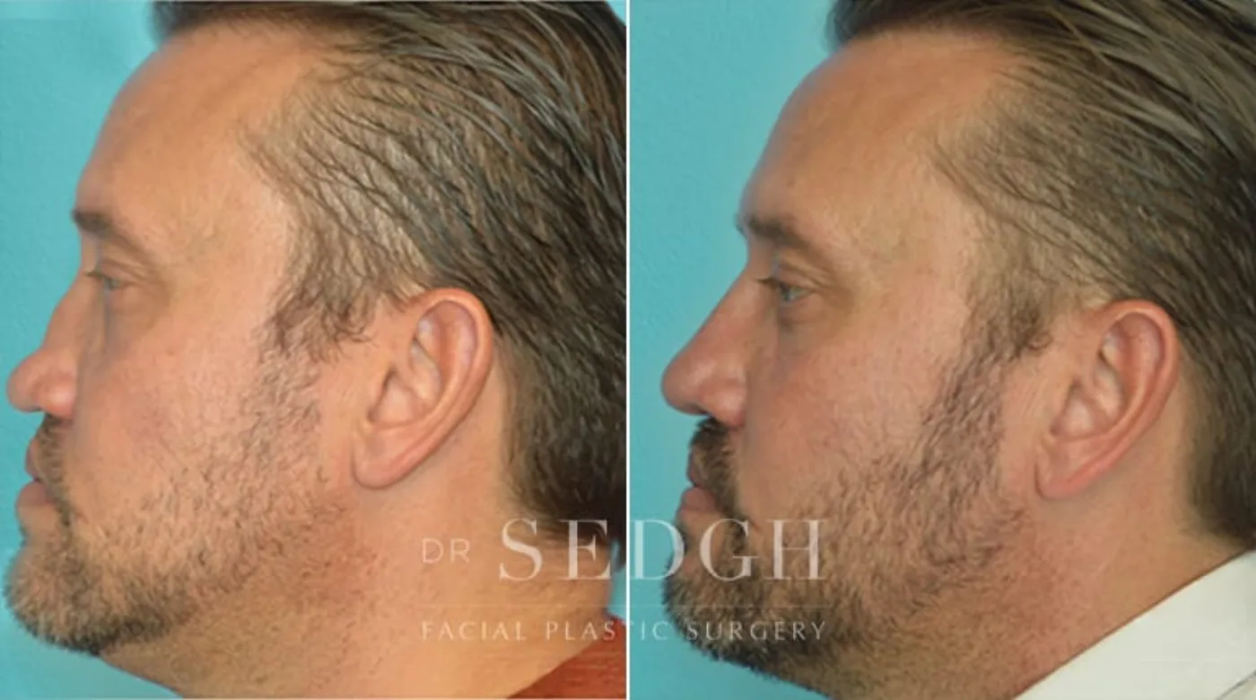 Patient 3 after Male Rhinoplasty, view 1