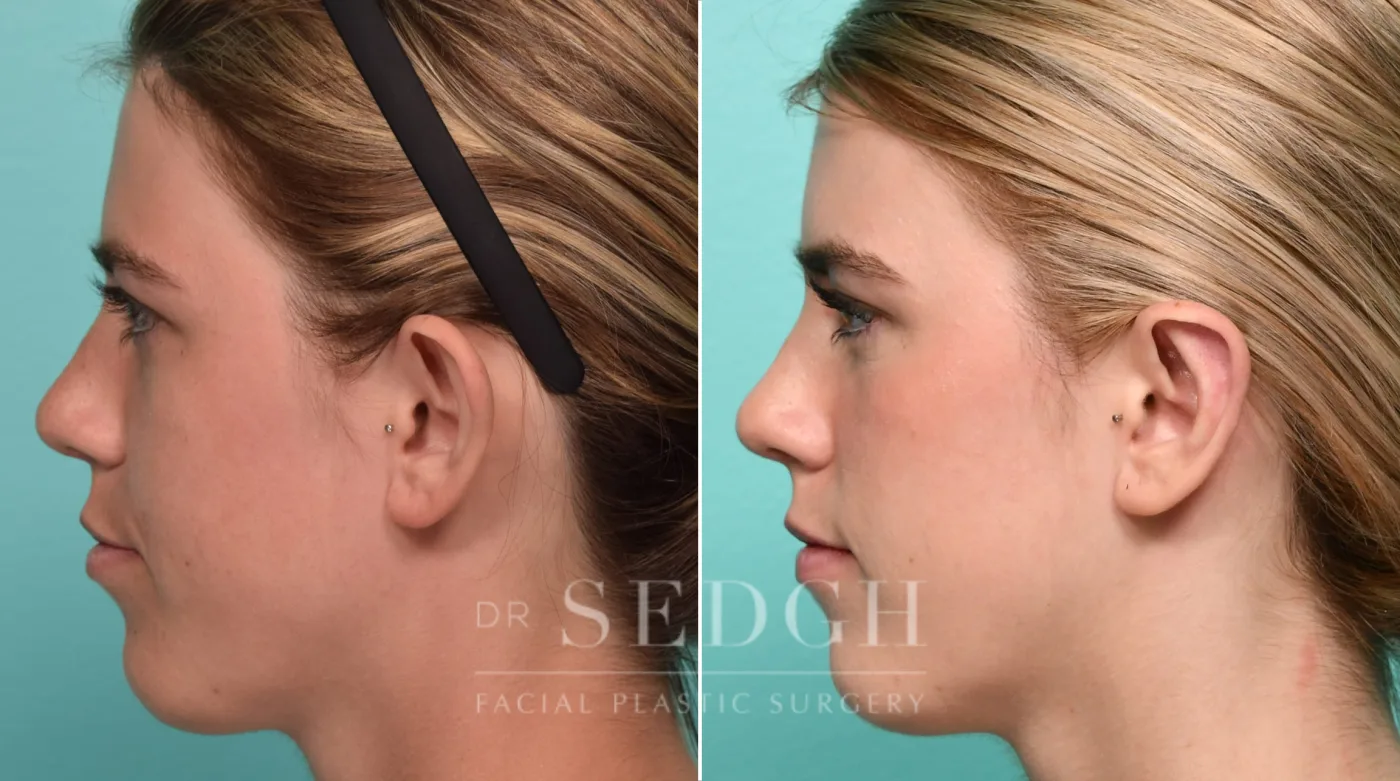 Patient 314 after Ear Pinning Surgery, view 1
