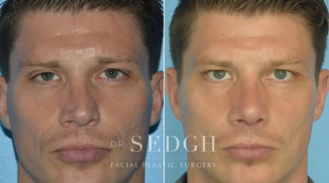 Patient 2 before Crooked Nose Surgery, view 1