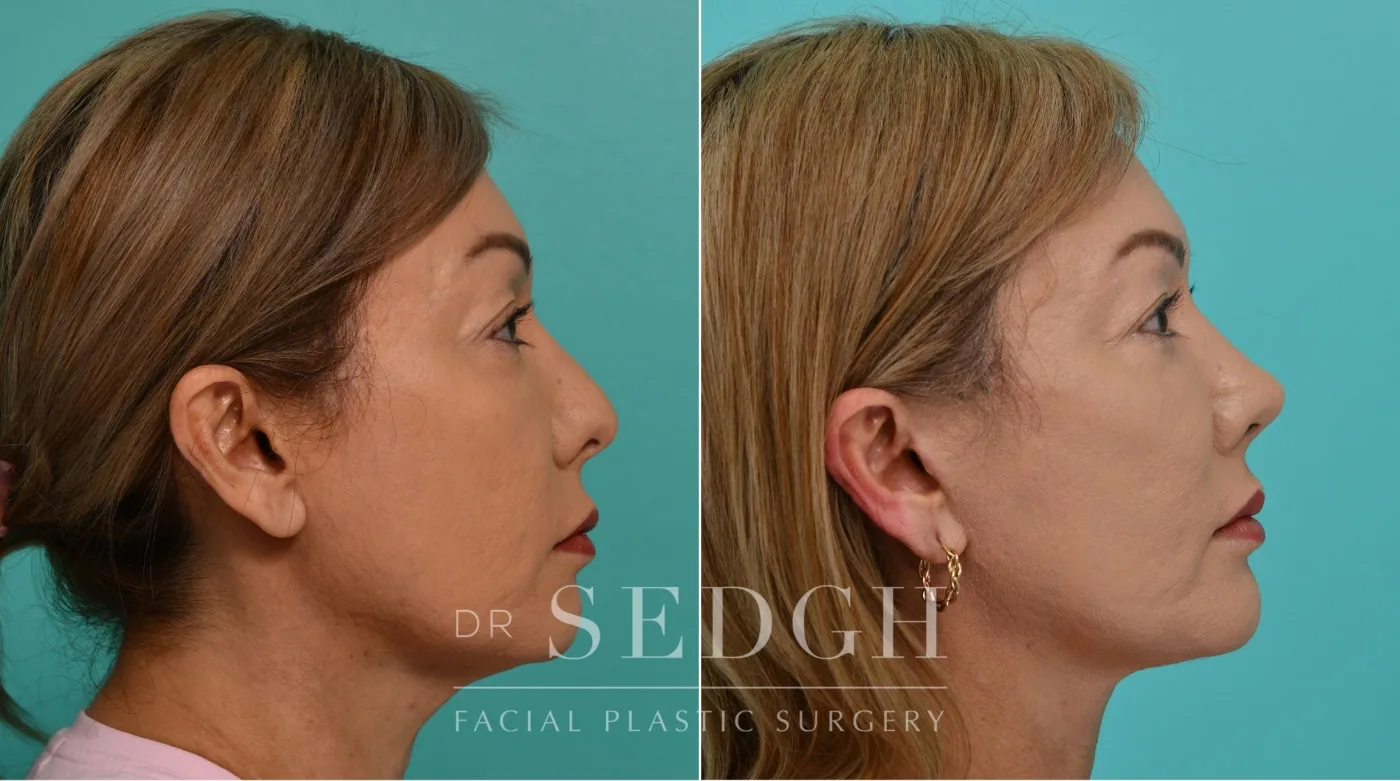 Patient 341 before Face Lift, view 3
